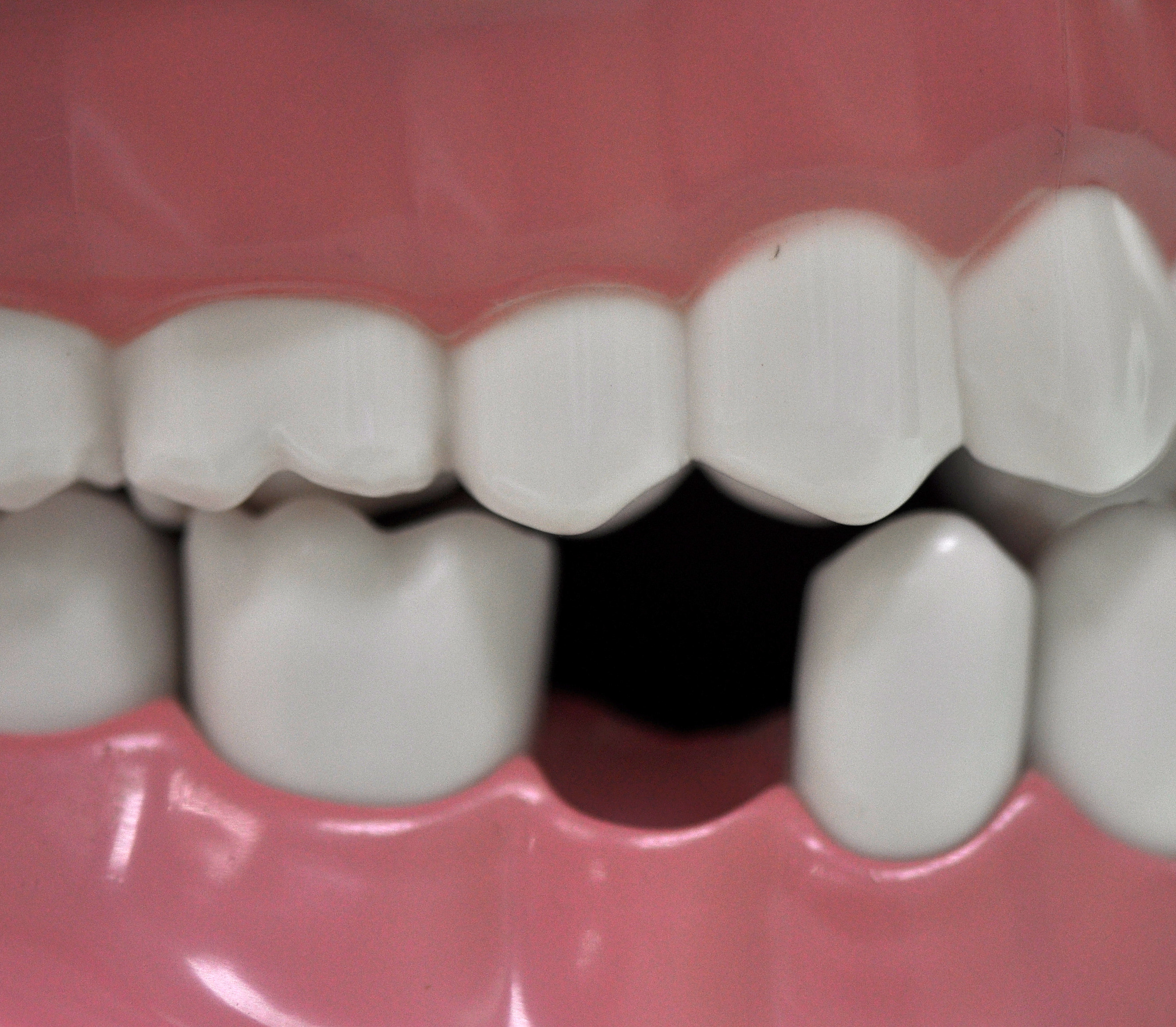 Smile Makers How to Replace Lost Teeth Implants, Bridges, Dentures