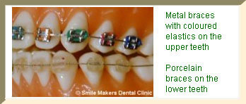 Metal braces with coloured elastics