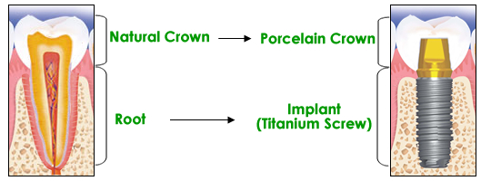 dental-implants