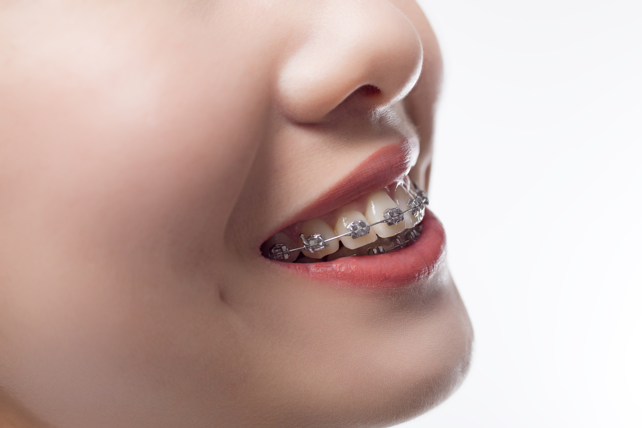 How Much Do Braces Cost To Straighten My Teeth? Smile Makers Dental How Much Do Braces Cost To Straighten My Teeth? Smile Makers Dental
