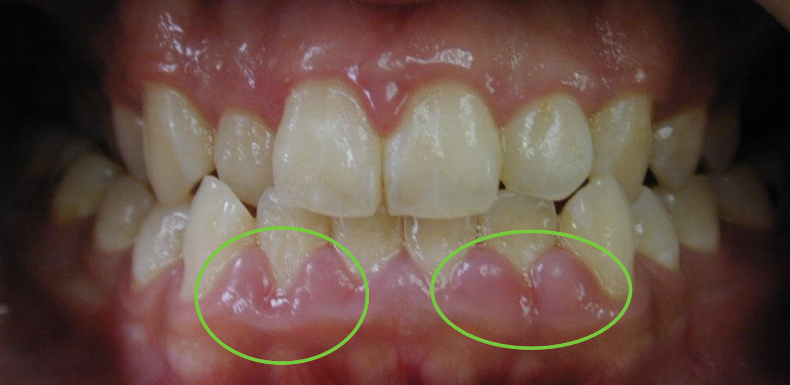 Signs of Gum Disease